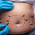 What You Need to Know About Tummy Tuck Cosmetic Surgery