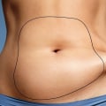 A Comprehensive Look at Liposuction Before-and-After Photos