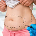 The Ultimate Guide to Tummy Tuck Surgery and Recovery Experience