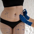 Areas of the Body That Can Be Treated for a Tummy Tuck Cosmetic Surgeon