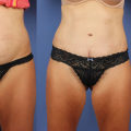 Maximizing Your Results: All About Tummy Tuck Surgery