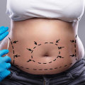 How to Become a Qualified and Experienced Tummy Tuck Cosmetic Surgeon