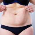 Qualifications and Certifications for Tummy Tuck Surgeons