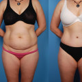 How to Choose the Right Cosmetic Surgeon for Your Tummy Tuck