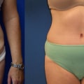 Recovering and Achieving Results After a Tummy Tuck Procedure