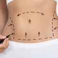 What You Need to Know About a Tummy Tuck Cosmetic Surgeon