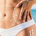 Types of Liposuction: A Comprehensive Guide to Body Contouring Procedures