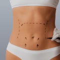 A Comprehensive Look at Incision Placement for Tummy Tuck Surgery