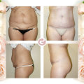 How to Choose the Best Tummy Tuck Cosmetic Surgeon: Tips and Before-and-After Photos