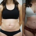 Factors That Affect the Cost of Tummy Tuck Surgery