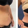 Financing Options for Tummy Tuck Surgery