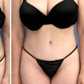 Understanding Different Types of Tummy Tuck Results: A Comprehensive Guide