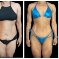 Before-and-After Photos of Tummy Tuck Patients: What You Need to Know