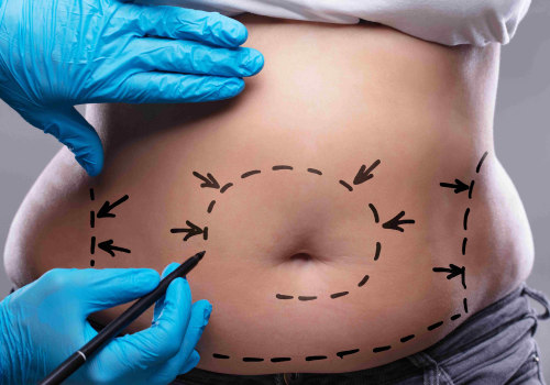 What You Need to Know About Tummy Tuck Cosmetic Surgery