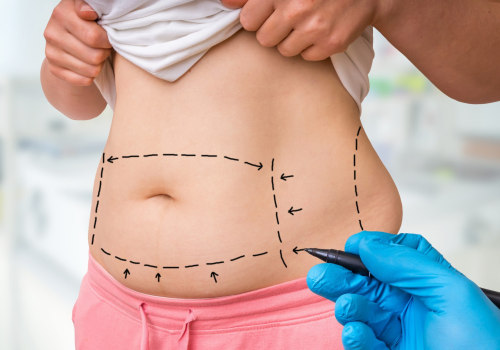 The Ultimate Guide to Tummy Tuck Surgery and Recovery Experience