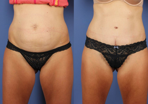 Maximizing Your Results: All About Tummy Tuck Surgery