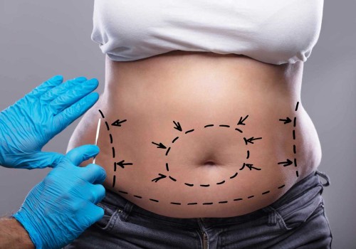 How to Become a Qualified and Experienced Tummy Tuck Cosmetic Surgeon