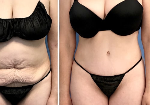 Types of Tummy Tuck Surgery: What You Need to Know