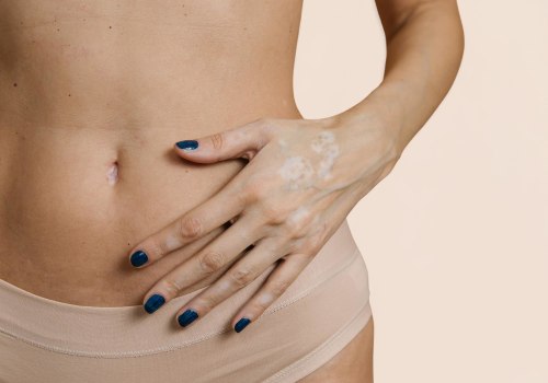 Body Lift Patient Experiences: What You Need to Know Before Undergoing a Tummy Tuck