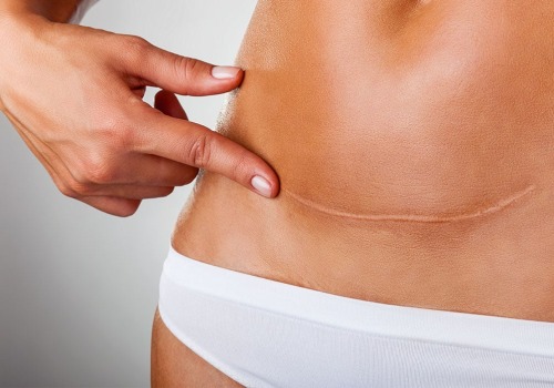 Real Patient Photos: The Key to Finding the Right Tummy Tuck Cosmetic Surgeon