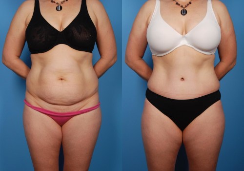 How to Choose the Right Cosmetic Surgeon for Your Tummy Tuck