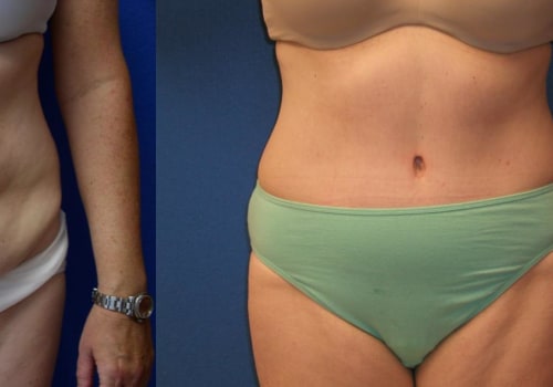 Recovering and Achieving Results After a Tummy Tuck Procedure