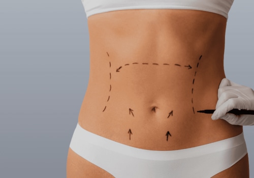 A Comprehensive Look at Incision Placement for Tummy Tuck Surgery