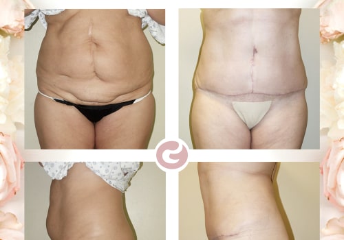 How to Choose the Best Tummy Tuck Cosmetic Surgeon: Tips and Before-and-After Photos