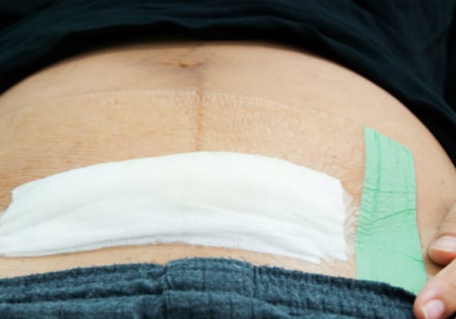 The Complete Guide to Follow-Up Appointments After Tummy Tuck Surgery