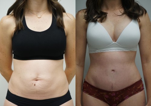 Factors That Affect the Cost of Tummy Tuck Surgery