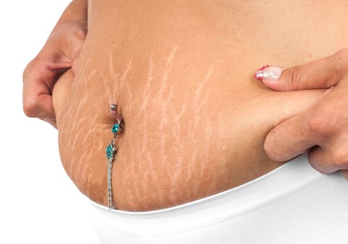 Risks and Complications of Tummy Tuck Surgery