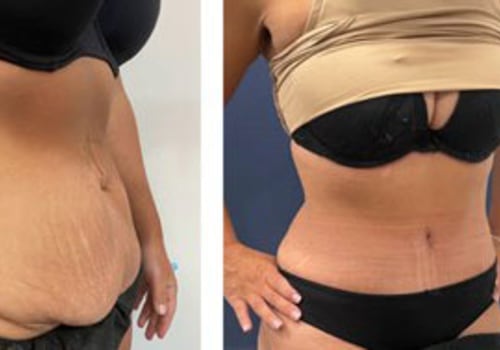 Financing Options for Tummy Tuck Surgery