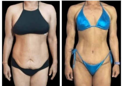 Before-and-After Photos of Tummy Tuck Patients: What You Need to Know